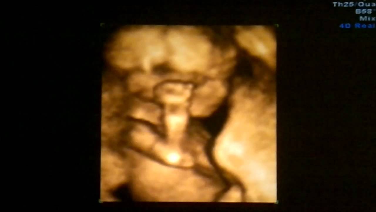 3d 4d ultrasound